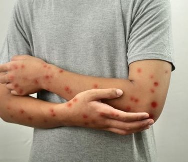 Brasil Registra 81 Ocorrências de Mpox em 2026; Saiba Como Identificar os Principais Sinais da Infecção.