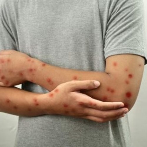 Brasil Registra 81 Ocorrências de Mpox em 2026; Saiba Como Identificar os Principais Sinais da Infecção.