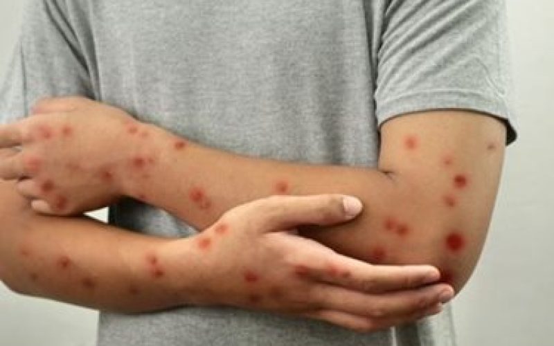 Brasil Registra 81 Ocorrências de Mpox em 2026; Saiba Como Identificar os Principais Sinais da Infecção.