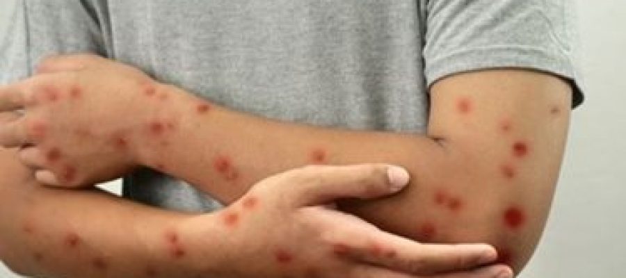 Brasil Registra 81 Ocorrências de Mpox em 2026; Saiba Como Identificar os Principais Sinais da Infecção.